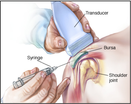 Corticosteroid injection pain