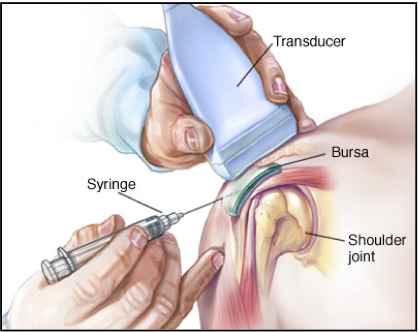 Steroid injection elbow joint