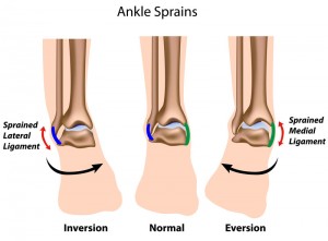 ankle sprain